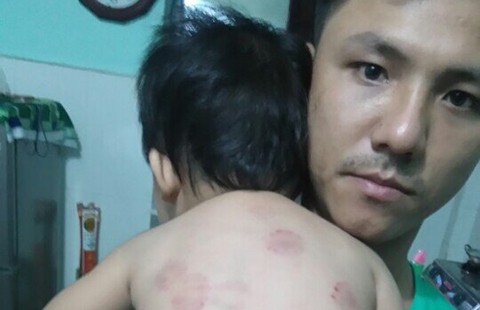Ngày đầu đi học, bé 13 tháng bị bạn cắn tím lưng