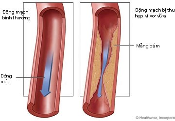 Mối nguy về calcium trong động mạch vành