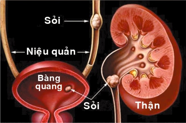 Sỏi thận trên đà tăng vì nhiệt độ tăng