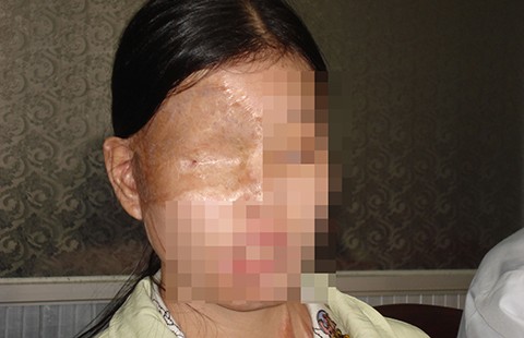 Bỏng do acid đâu phải dấu chấm hết