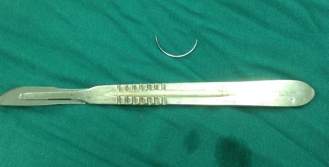 Lấy cây kim nằm trong bụng bệnh nhân suốt 15 năm