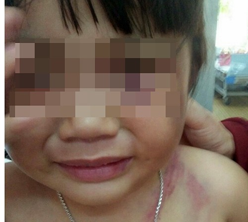 Cha dượng đánh bầm mình bé gái 3 tuổi bị bắt