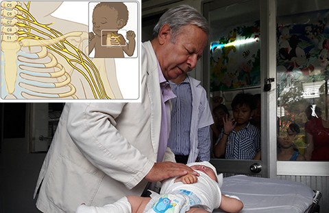 Nguy cơ trẻ bị liệt cánh tay sau sinh