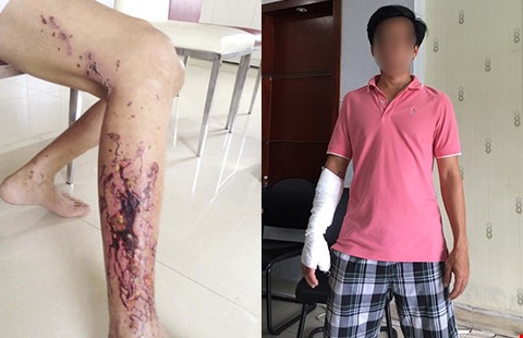 Bỏng tay, hoại tử chân vì chất thông cống