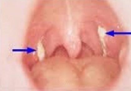 Dịch bệnh bạch hầu lây lan nhanh ở Bình Phước