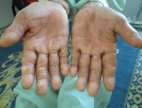 Hội chứng viêm da dày sừng chết người có nguy cơ trở lại