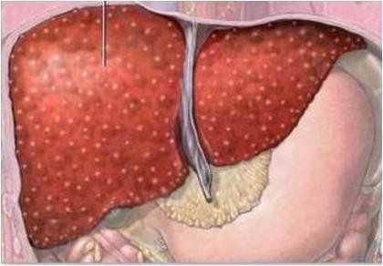 Gần 30.000 ca tử vong do viêm gan virus/năm