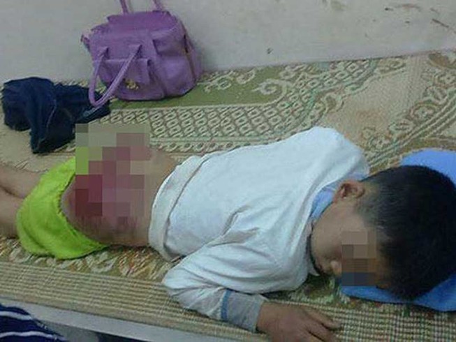 Cha đánh con trai 13 tuổi nhập viện cấp cứu
