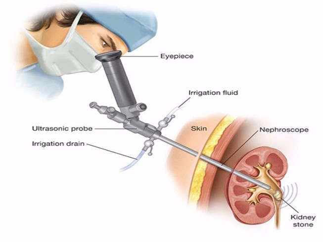 Áp dụng thành công phương pháp lấy sỏi thận qua da