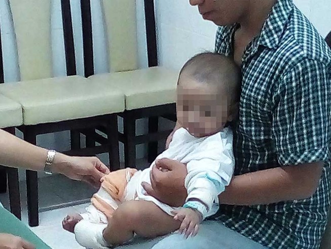 Sơ cứu sai cách, trẻ phỏng nhẹ thành nặng