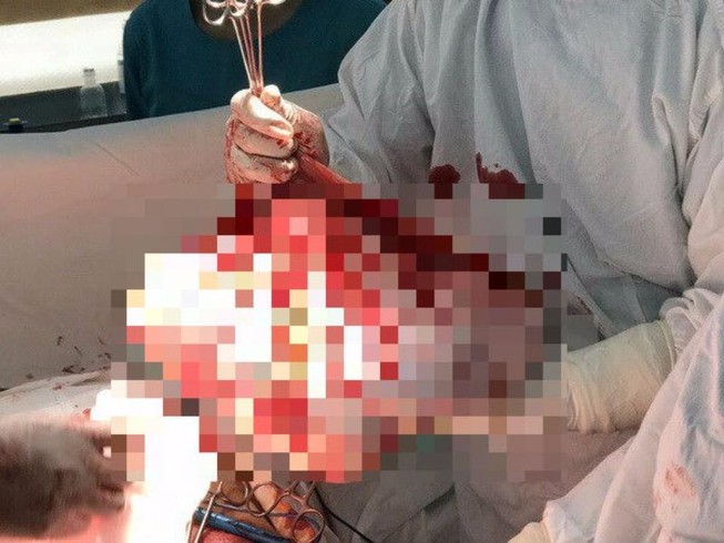 Bóc tách thành công khối u buồng trứng khổng lồ