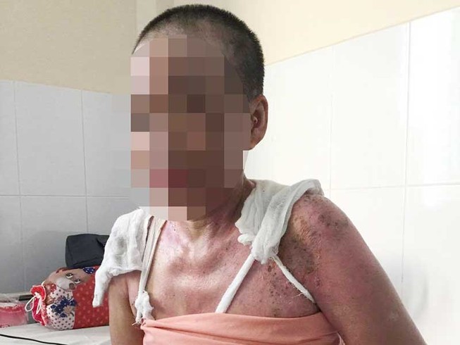 Đi phụ quán cơm, bị tạt nước sôi bỏng nặng