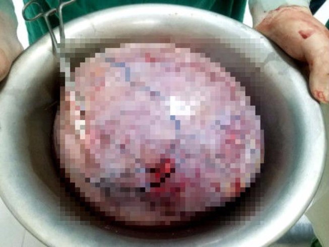 Bụng như mang thai 8 tháng, đi khám 'ra' khối u 5,5kg