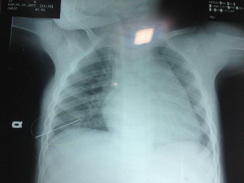 Bé 3 tuổi bị thủng phổi vì kim đâm xuyên ngực