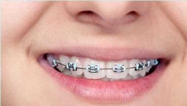 Cách giảm đau buốt sau khi niềng răng