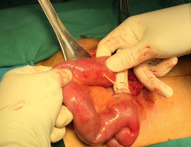 Nuốt tăm tre, bị đâm thủng ruột mà không hay biết