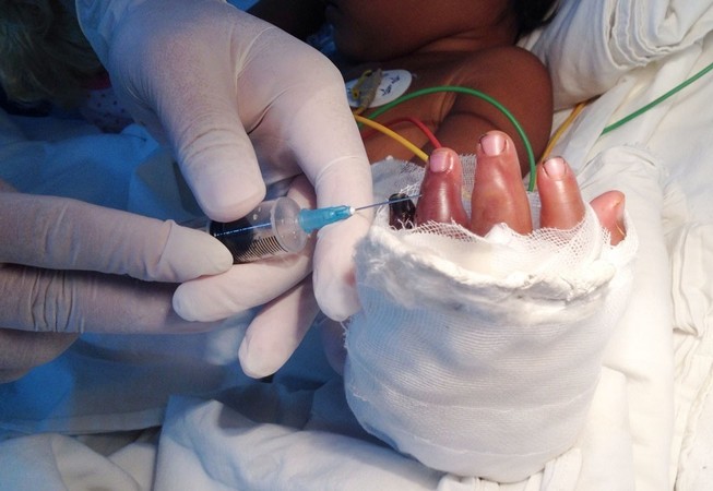 Bé 2 tuổi theo mẹ đi làm bị xích máy cắt gạch cắt lìa bàn tay