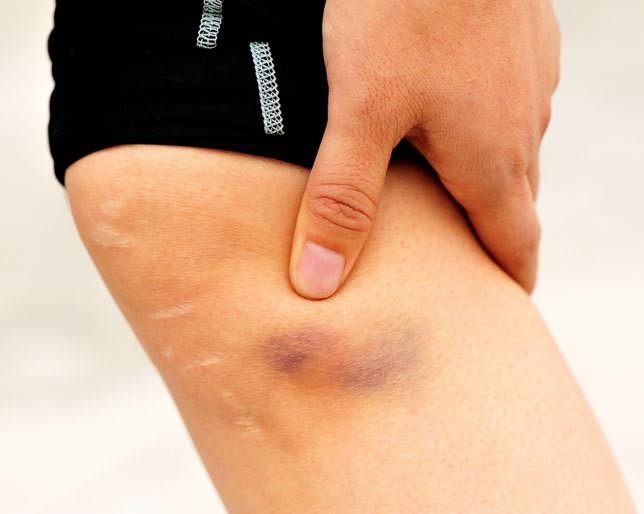 Cách chữa nhanh vết bầm tím trên da