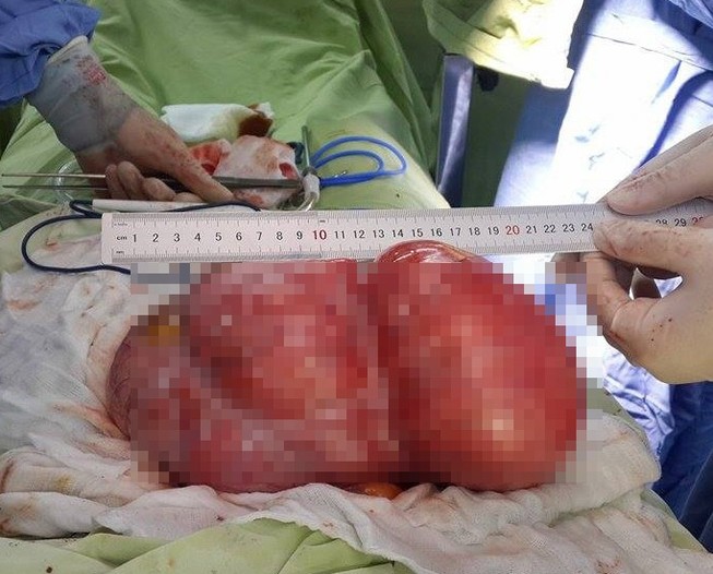 Cắt tử cung và buồng trứng lấy khối u hơn 4 kg