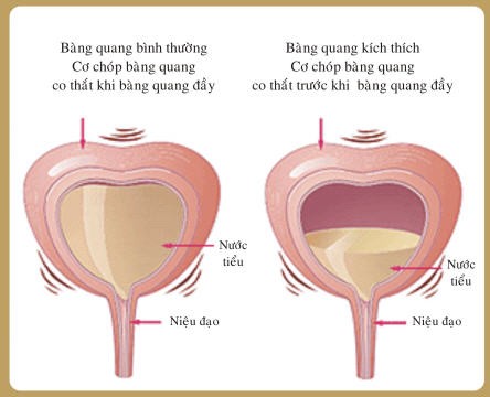 Đi tiểu nhiều, có phải bệnh lý?