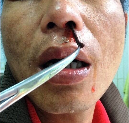 Uống nước suối bị đỉa chui vào lỗ mũi