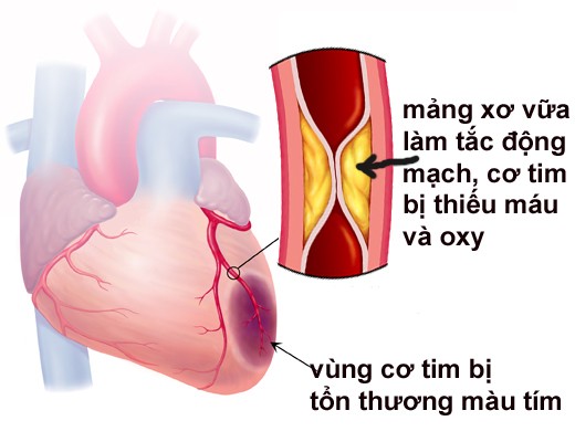 Những dấu hiệu sớm cảnh báo nhồi máu cơ tim