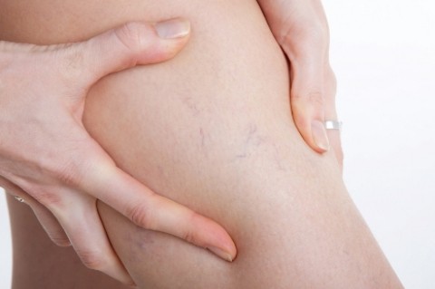8 điều cần biết về suy tĩnh mạch chân