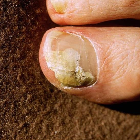6 mẹo dễ dàng giúp trị bệnh nấm móng