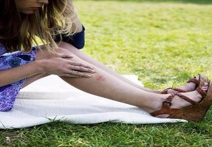 5 vết côn trùng cắn bạn không nên chủ quan