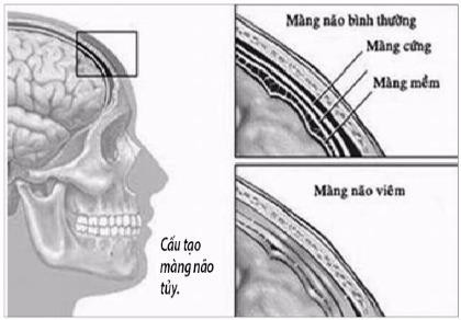 Lao màng não, thể lao nguy hiểm