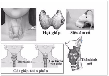 Ai dễ bị ung thư tuyến giáp?