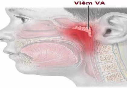 Những điều cần biết về viêm VA
