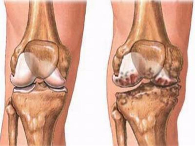 Thấp khớp cấp, thấp tim: Dùng thuốc gì, vào lúc nào?