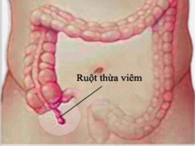 Dấu hiệu viêm ruột thừa