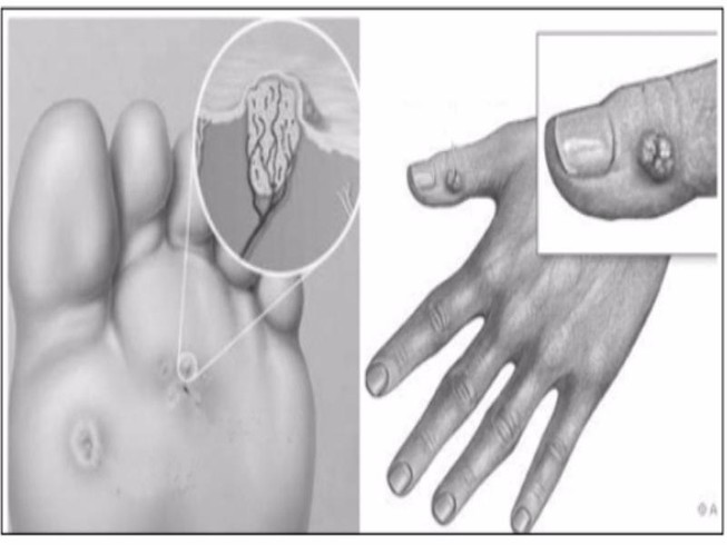 Mụn cóc và thuốc trị