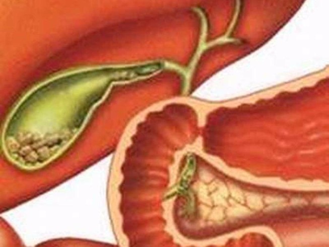Sỏi túi mật: Bệnh thầm lặng mà nguy hiểm
