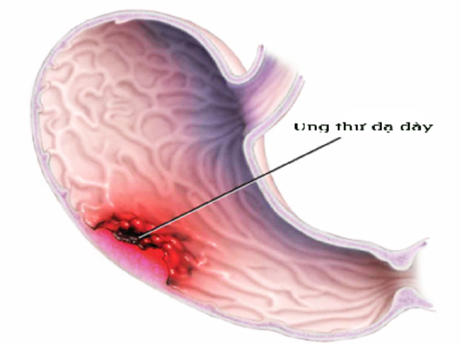 6 triệu chứng dự báo ung thư dạ dày thường bị bỏ qua