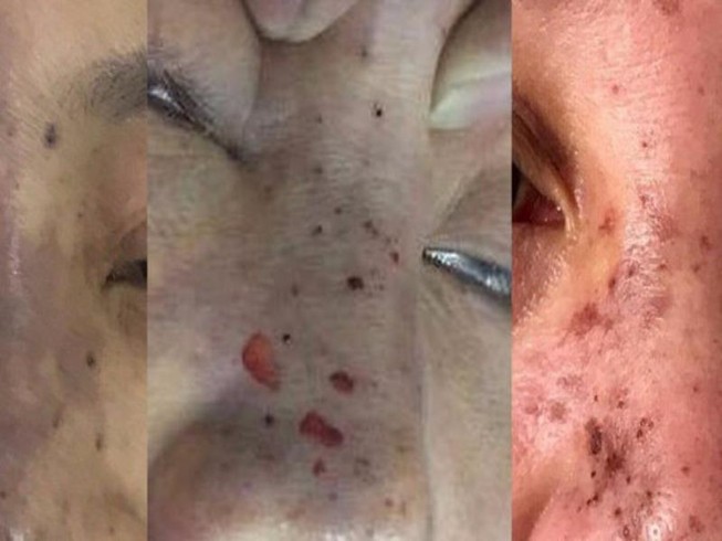 Bắt quả tang ‘bác sĩ' Hàn Quốc làm đẹp chui ở khách sạn