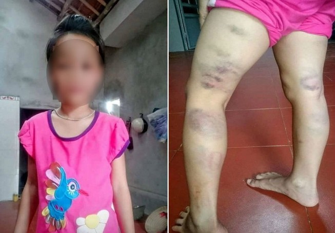 Học sinh lớp 2 bị cô giáo đánh tím đùi vì viết sai chính tả
