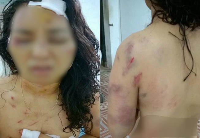Khởi tố kẻ đánh vợ cũ tổn hại 28% sức khỏe