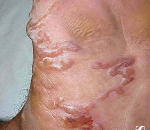 Ăn gỏi, rau sống: Ngứa khắp người do ký sinh trùng bò dưới da