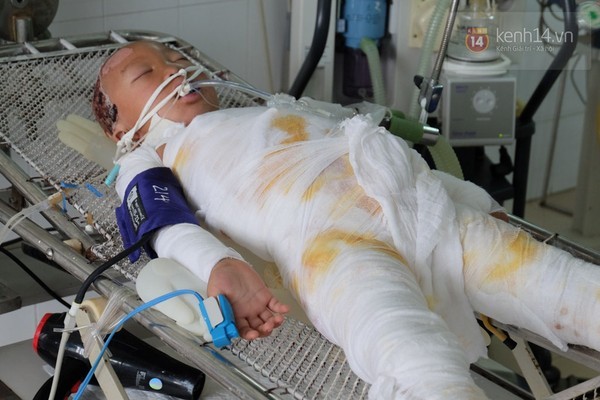 Ngã vào nồi canh 200 lít, bé gái 6 tuổi đang nguy kịch - ảnh 1