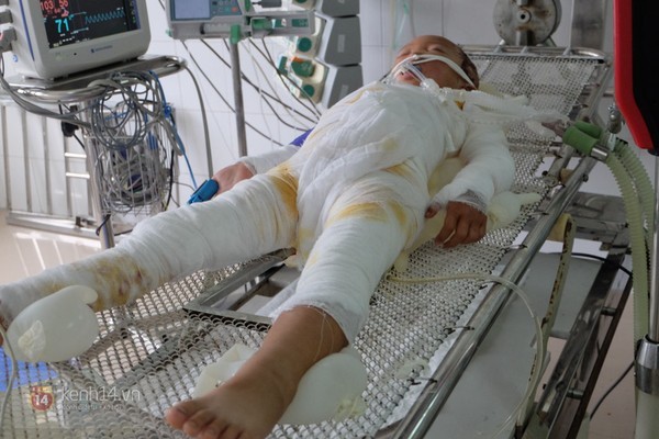 Ngã vào nồi canh 200 lít, bé gái 6 tuổi đang nguy kịch - ảnh 3