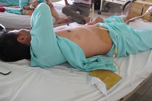 Một nạn nhân bị cắt cậu nhỏ điều trị tại Bệnh viện Chợ Rẫy Một nạn nhân bị cắt cậu nhỏ điều trị tại Bệnh viện Chợ Rẫy