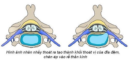 Dấu hiệu đau thần kinh tọa hay thoát vị đĩa đệm - ảnh 1