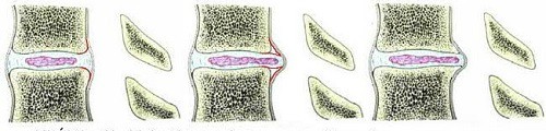 Dấu hiệu đau thần kinh tọa hay thoát vị đĩa đệm - ảnh 2