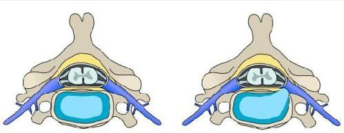 Dấu hiệu thoát vị đĩa đệm cột sống cổ - ảnh 1