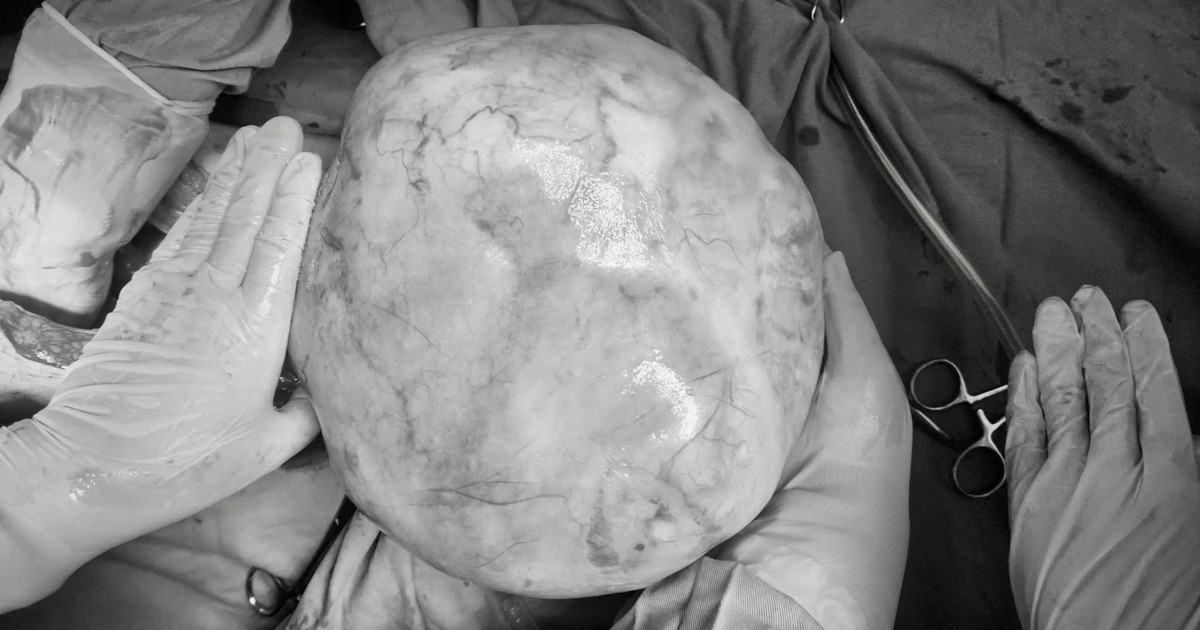 Tưởng bụng to do dậy thì, không ngờ bé gái mang khối u buồng trứng 4,3 kg