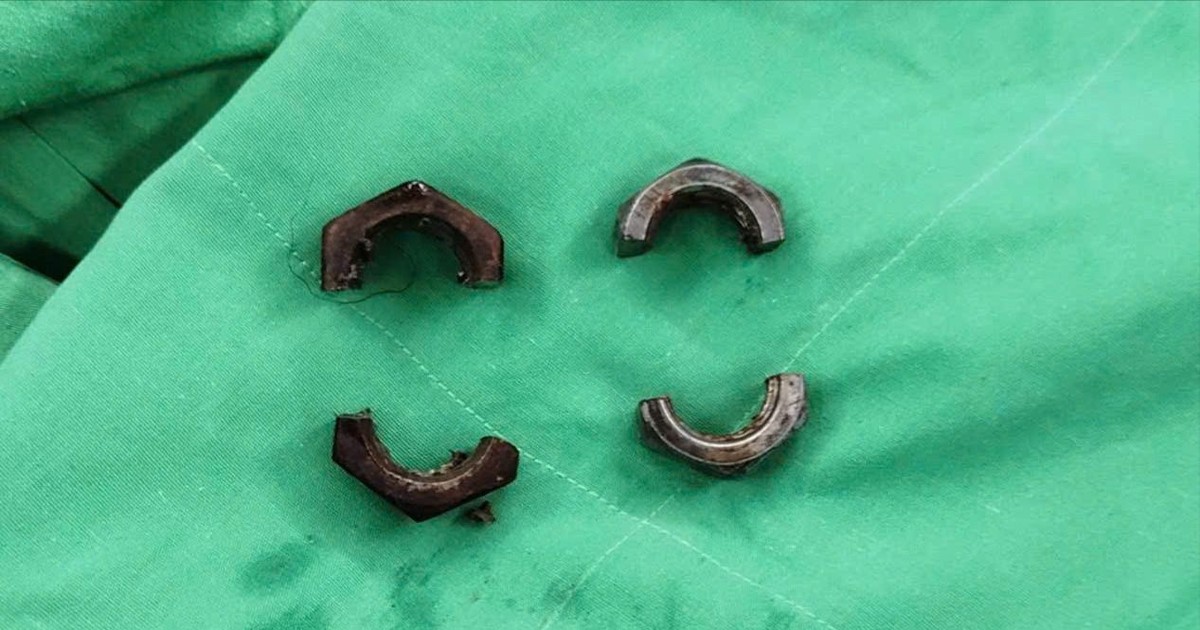Đeo đai ốc kim loại cho 'cậu nhỏ' suốt 1 tháng, người đàn ông phải đi cấp cứu