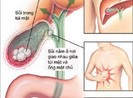 Cách phòng sỏi mật tái phát sau mổ